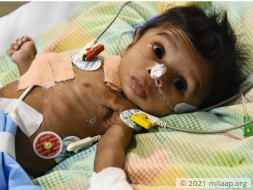 Help 9-month-old Elisha Who Has Lost 90% Of Her Small Intestine