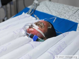 50% Of This Baby’s Body Is Burnt And He’s Struggling To Live