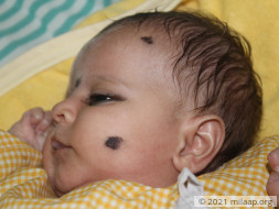 2-Month-Old Baby's Enlarged Liver Will Kill Her Without Urgent Help
