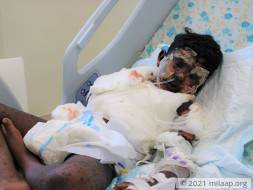 Skin Disease Has Ravaged This Boy's Face And Body, Needs Urgent Help