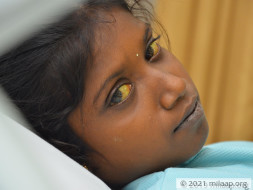 Sivaranjini needs your help to undergo Liver transplant