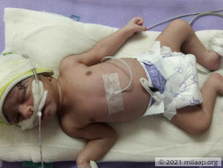 Help Baby of Mosarrat Survive