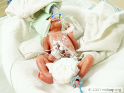 Twin babies of meenu needs your help to survive