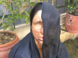 I am fundraising to help acid attack survivor Sheela