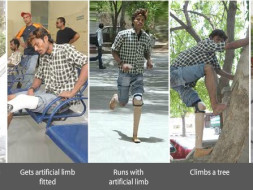 Fundraising to help Jaipur foot provide artificial limbs to 200 amputees. Support my project!