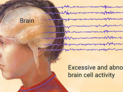 Help us Cure People with Epilepsy