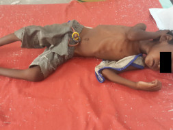 Save the lives of severely malnourished children in Bihar
