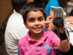Lend a Hand to amputees - 3D printed Prosthetics