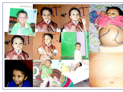 Help Ayush Fight A Rare Genetic Disorder - Gaucher Type 3