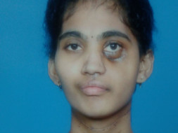 Help Jyothi undergo radiotherapy