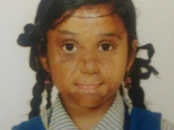 Madhupriya Needs Your Help To Recover From Severe Burns