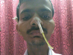 Chandrakant Rasal- Tongue Cancer