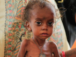 You can save the lives of 40 malnourished children