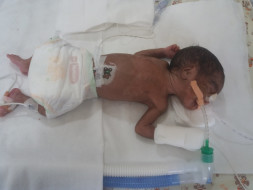 Help twin babies of Ramani get ventilator support