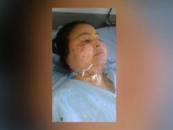 Save My Daughter Neeta From An Aggravating Lupus Disease