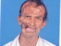 Help this 48-year-old fisherman with facial deformity