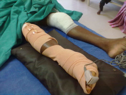 Help for Mariyappan, a victim of road accident
