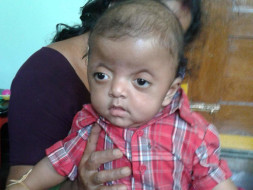 Help Vibhu Get Treated For Apert Syndrome