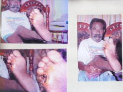 Help me to fight blocked veins ( Right leg to Heart )