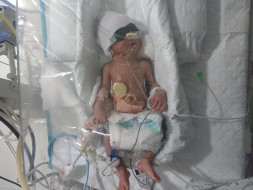 Nilam's New-Born Twins Need Your Help Funding Their Treatment