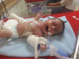 Help This Premature Baby Get Ventilator Support