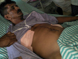 Help Srinivas Undergo MDCT Chest Surgery