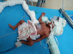 Help Save My 12-days-old Daughter