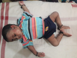 1-year-old Vignesh Has Been Suffering From Severe Diarrhea Since Birth