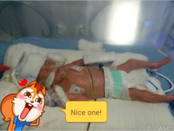 Need Help for a preterm baby