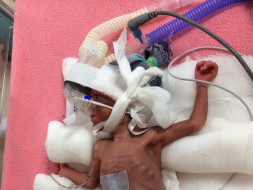 Help Baby of Sumedha Get Ventilator Support