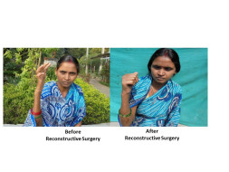 Reconstructive surgery to address deformities in women