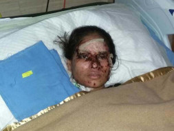 In Memory of Salma, Saving Relief Fund For Acute Acid Attack Cases