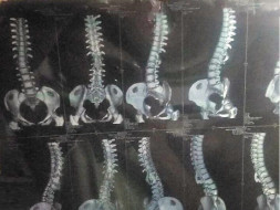 Help Manjula to undergo Backbone Surgery