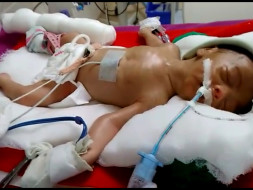 This premature-born is struggling and needs urgent help to survive
