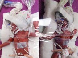 Help My New Born Twins Fight Battle Of Life