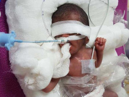 Extreme Premature Baby Fight Respiratory Distress