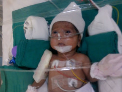Help Preterm Twins Of Pallavi Suffering From Chronic Lung Disease