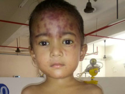 Help Gayatri, Who Needs A Bone Marrow Transplantation