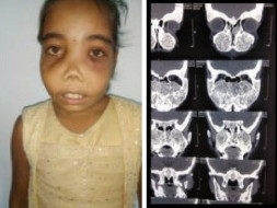 Save 11-Year-Old Girl From Fibrous Dysplasia