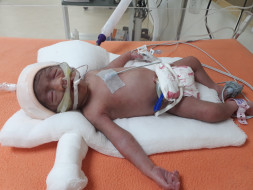 Fisherman Who Lost One Twin Before Birth Needs Help To Save The Other