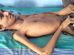 Help Rushit suffering from Muscular Dystrophy (DMD) a genetic disorder