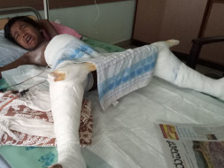 Help For My Daughter's Dislocated Hip Surgery
