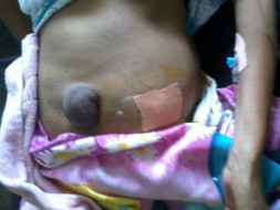 Mother's treatment liver cirrhosis