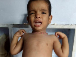 When We See Our Son Unable To Eat Basic Liquid Food,We Stop Eating Too
