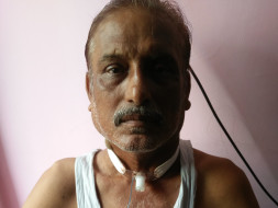Help Prabhat Defeat Cancer And Help Him Speak And Smile Again