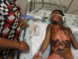 6 Year old kid Moiz Burnt Grievously in contact with high tension wire