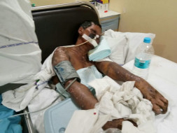 40-year-old Shevanta urgently needs treatment for severe skin disease