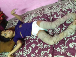 Help Ashifa To Overcome Her Physical Challenges