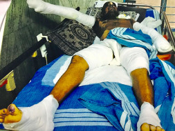 Help Prem Kumar To Recover From Skin Flame Burn
