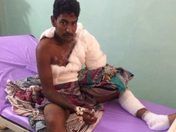 Help For Suresh's Surgery - Accidental Current shock - Kakinada